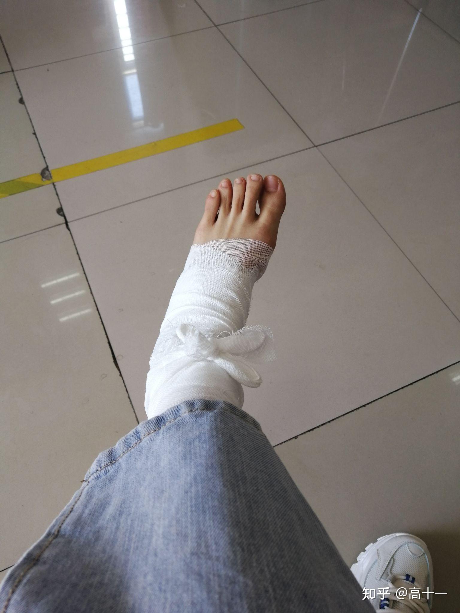 崴脚十天了,走路基本无碍,就是走一走脚踝还肿,该怎么办? - 知乎