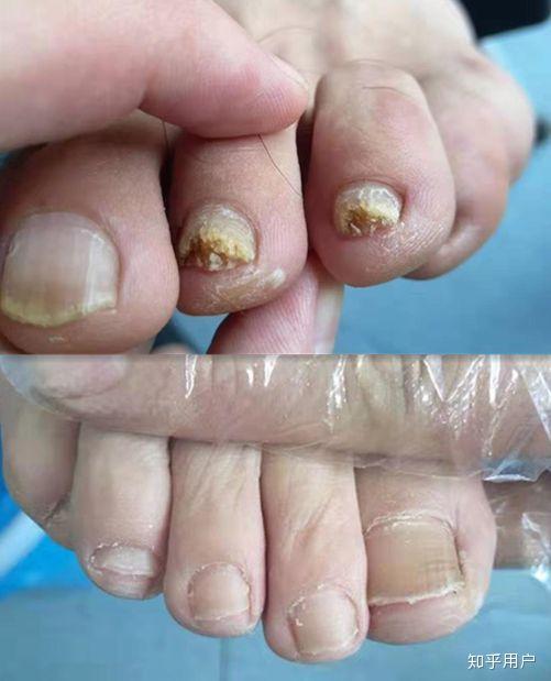 怎么治疗这种灰指甲脚上的据说要把指甲都去掉怎么去不会是硬拔吧