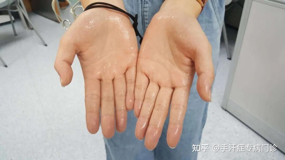 手掌出汗是什么原因