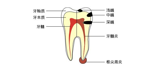 根尖周炎与牙髓炎的区别！ - 知乎