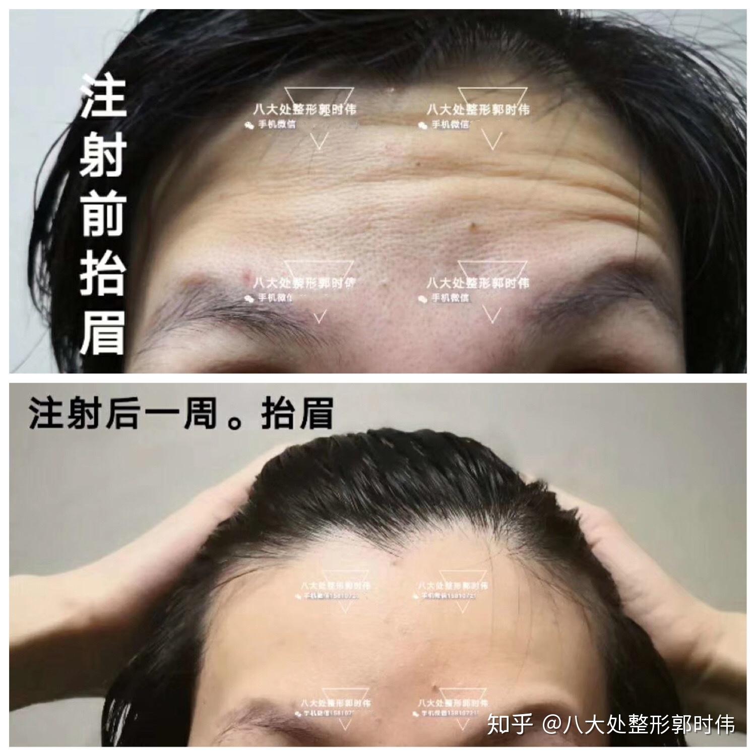 肉毒素注射八大处郭时伟系列案例十六