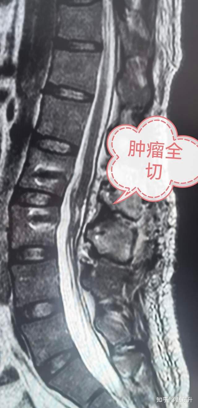 脊髓圆锥肿瘤术后会瘫痪