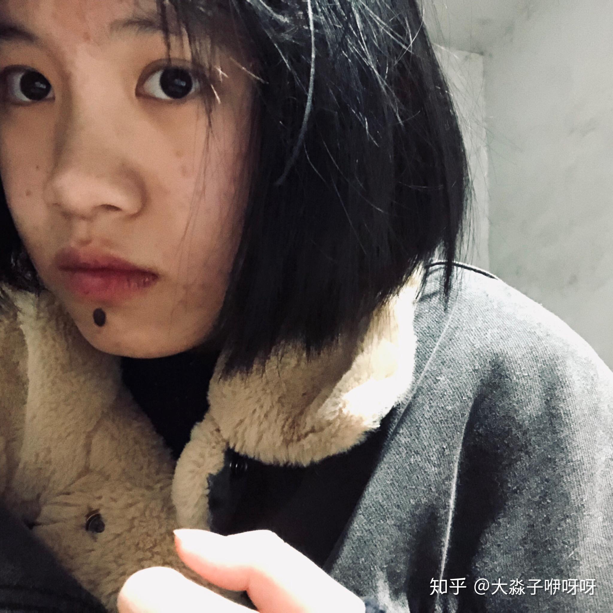 脸上有胎记是一种怎样的体验