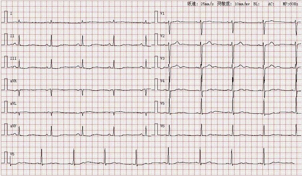 心电图图库丨u波异常直立倒置