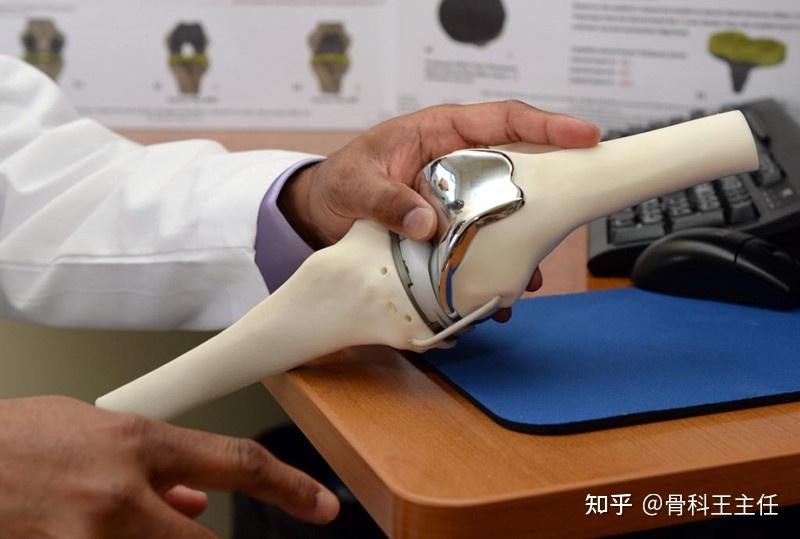 换膝盖也可以量身定制，定制膝关节置换到底好吗？ - 知乎