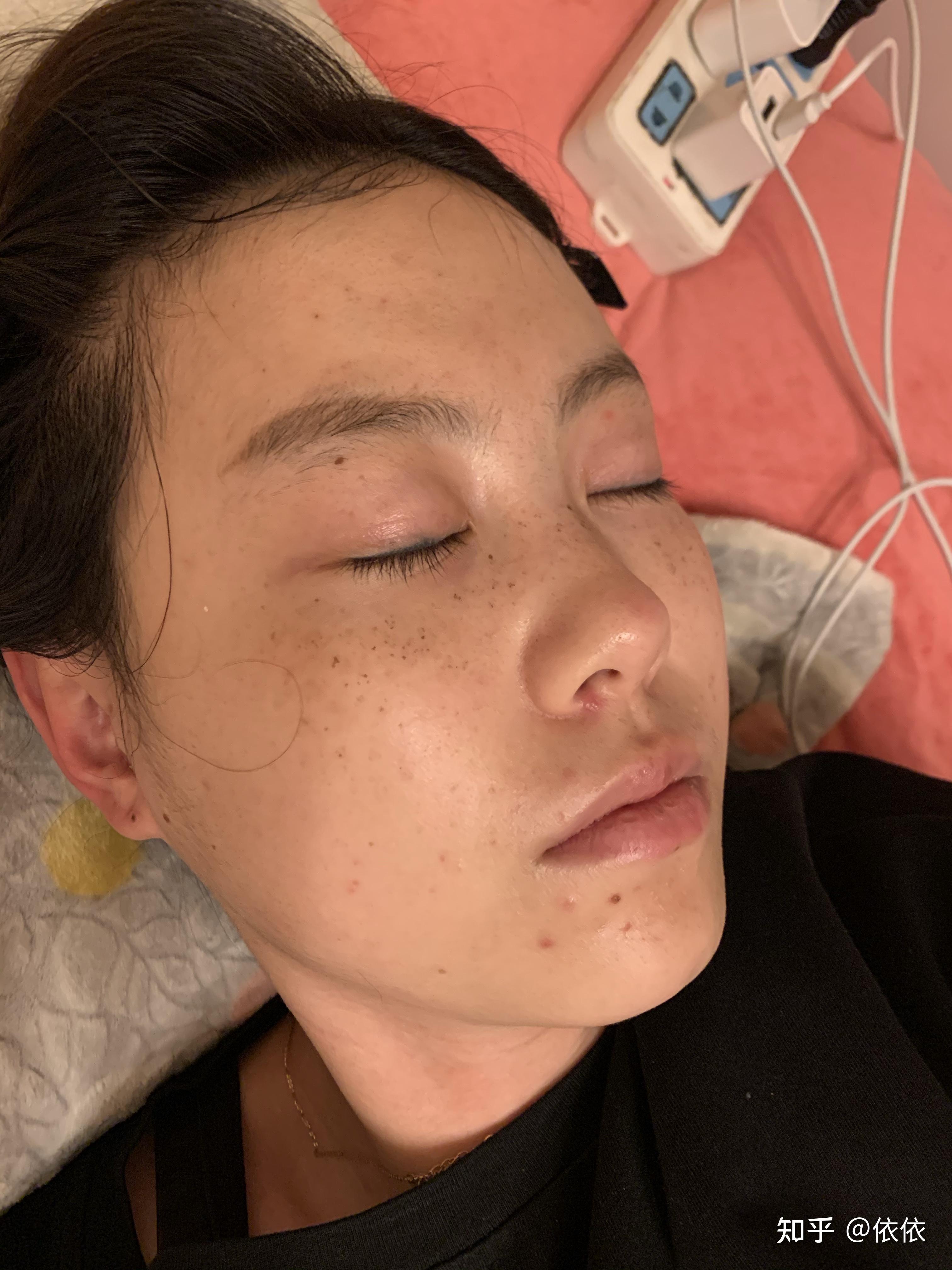 我的蜂巢皮秒祛斑记录