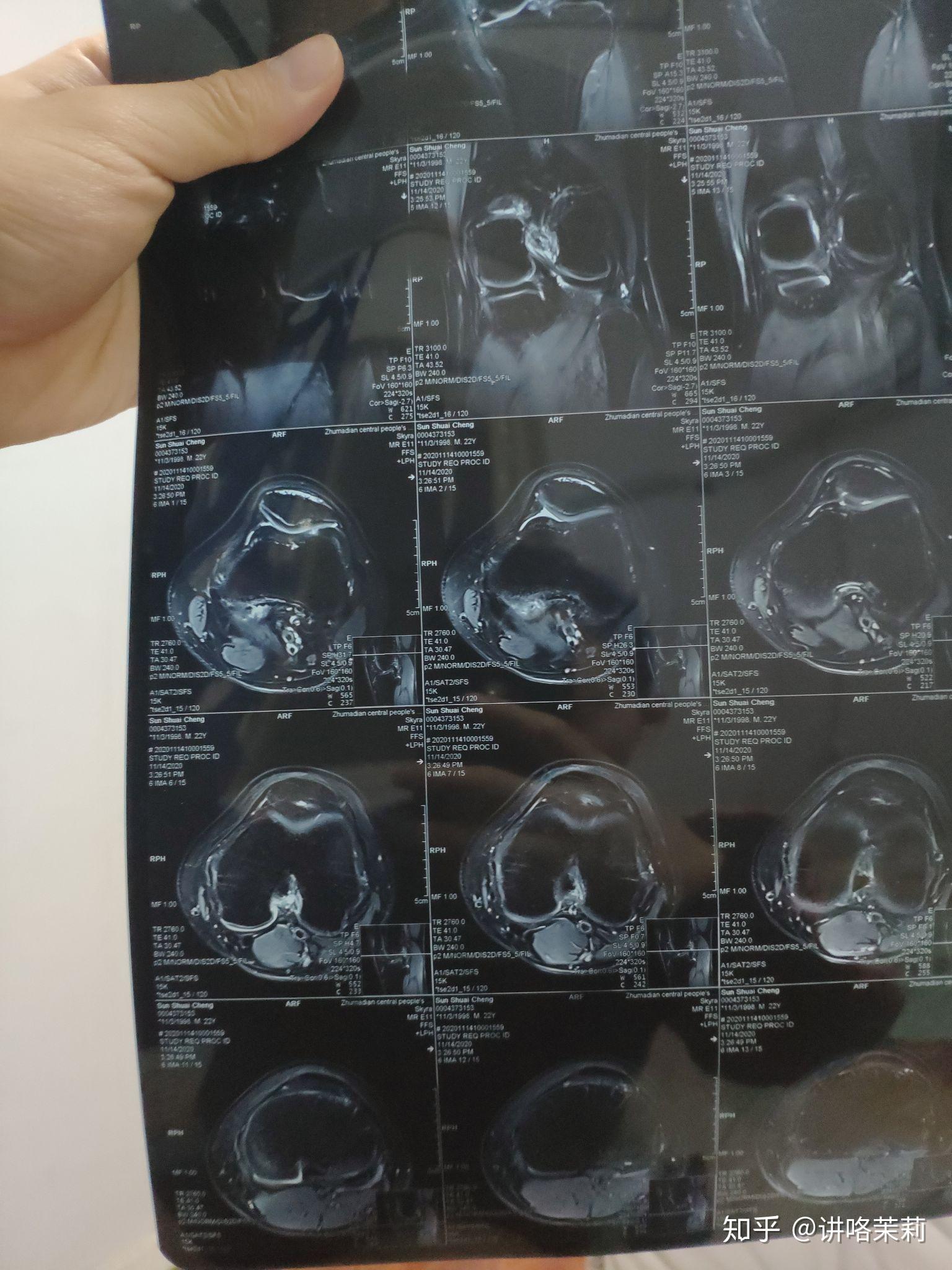 半月板后角變性怎麼康復訓練目前不能下蹲走路有點疼