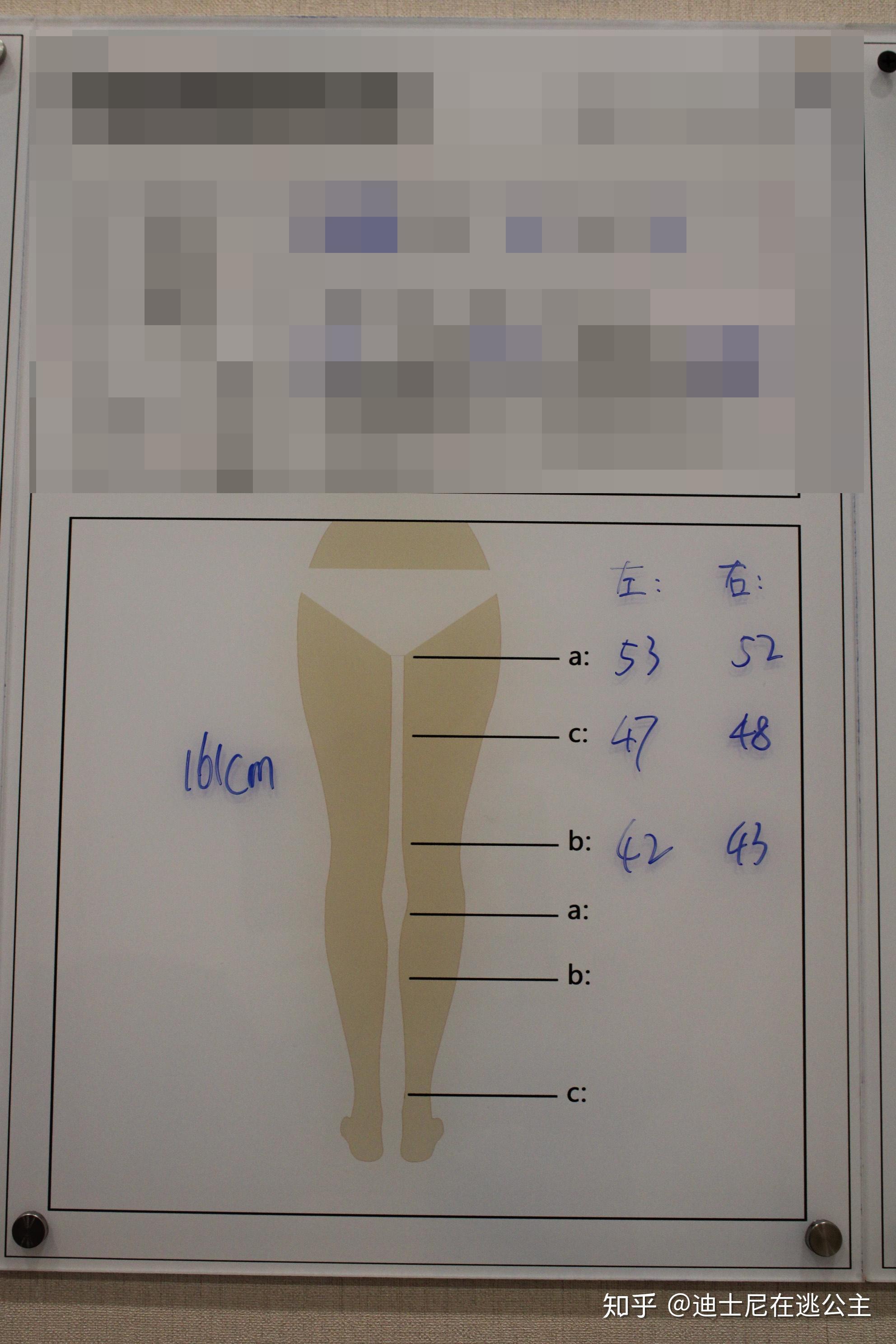 大腿吸脂纯脂肪2500cc腿围能瘦多少啊?