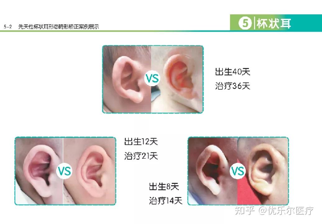 (隱耳除外,已知7週歲孩子隱耳無創矯正成功)