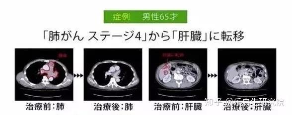 抗癌一物降一物 癌症实体瘤的 对手 原来它才是 知乎