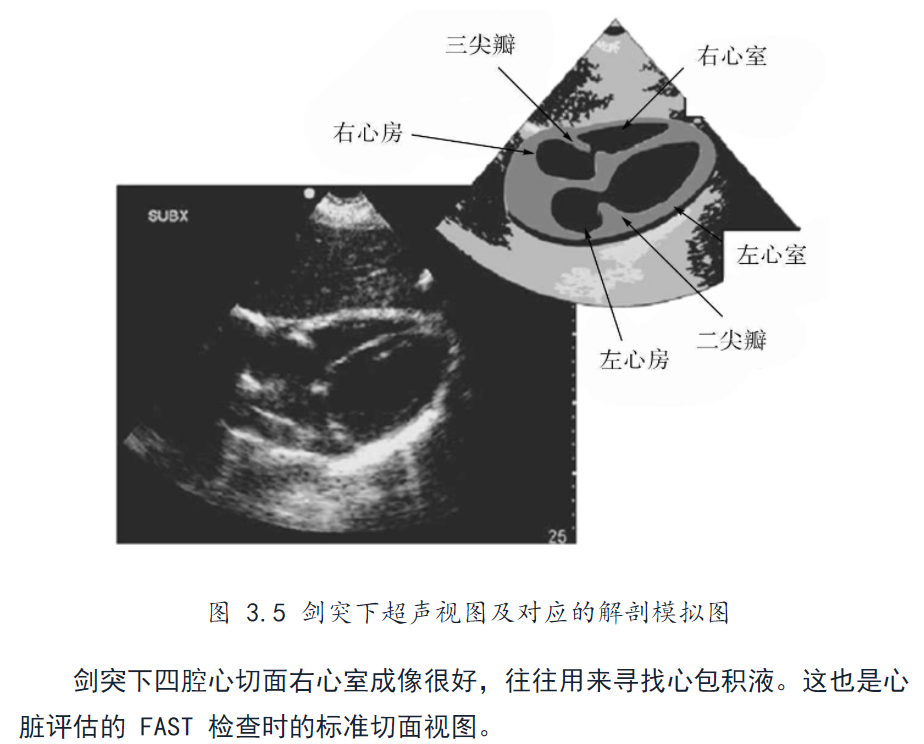 右心室调节束超声图像图片