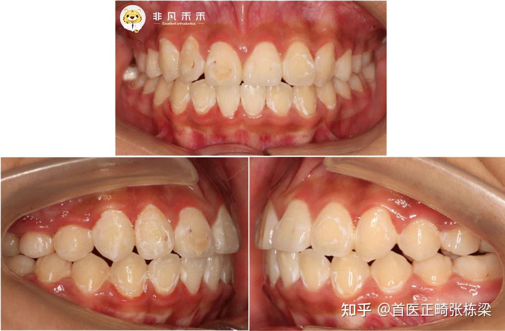 不拔牙矫正排齐严重牙齿拥挤一例