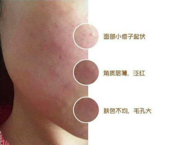 想问下这是不是玫瑰痤疮啊? - 知乎