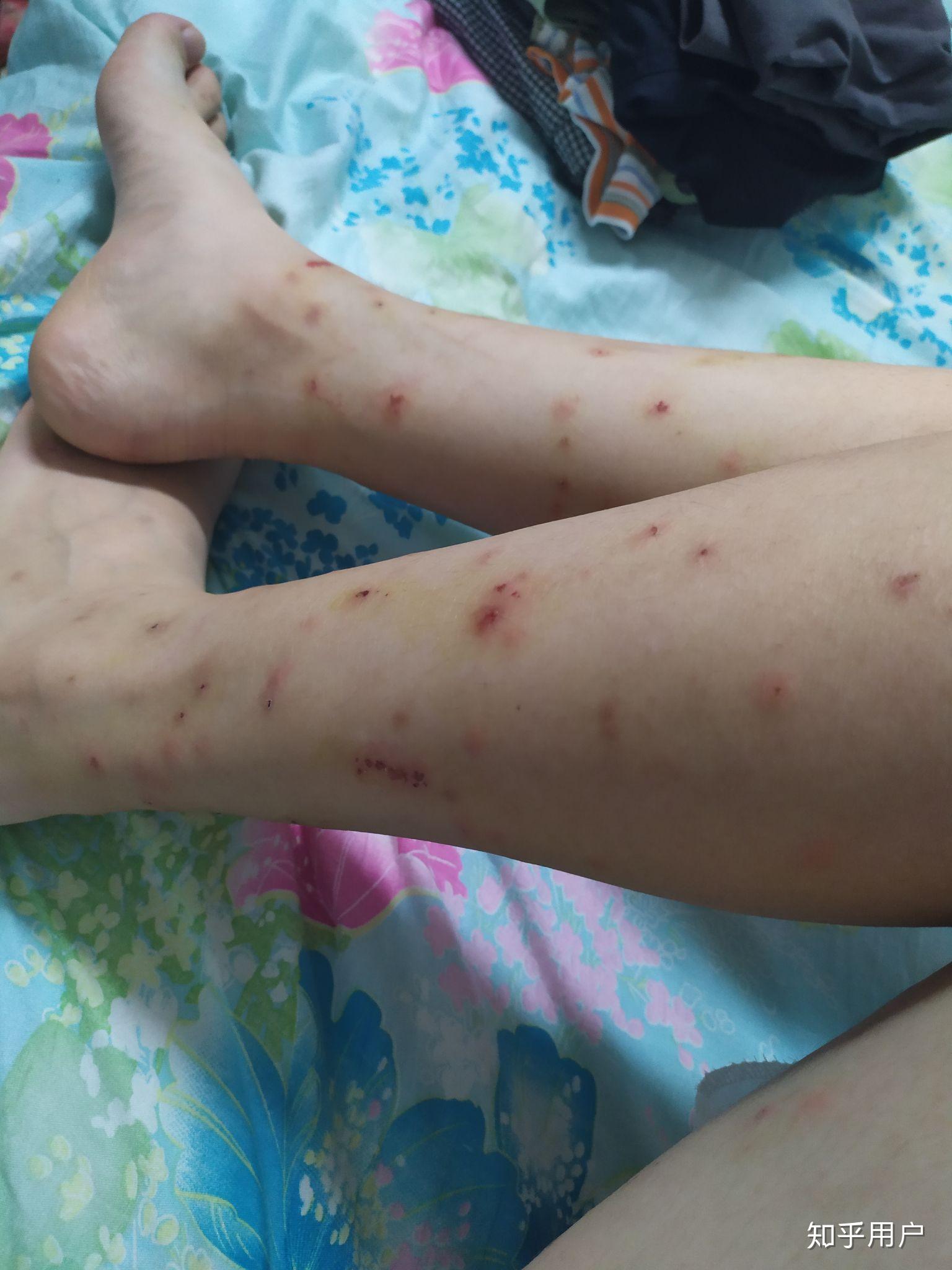被虫子咬了很多包是怎样一种体验? - 知乎