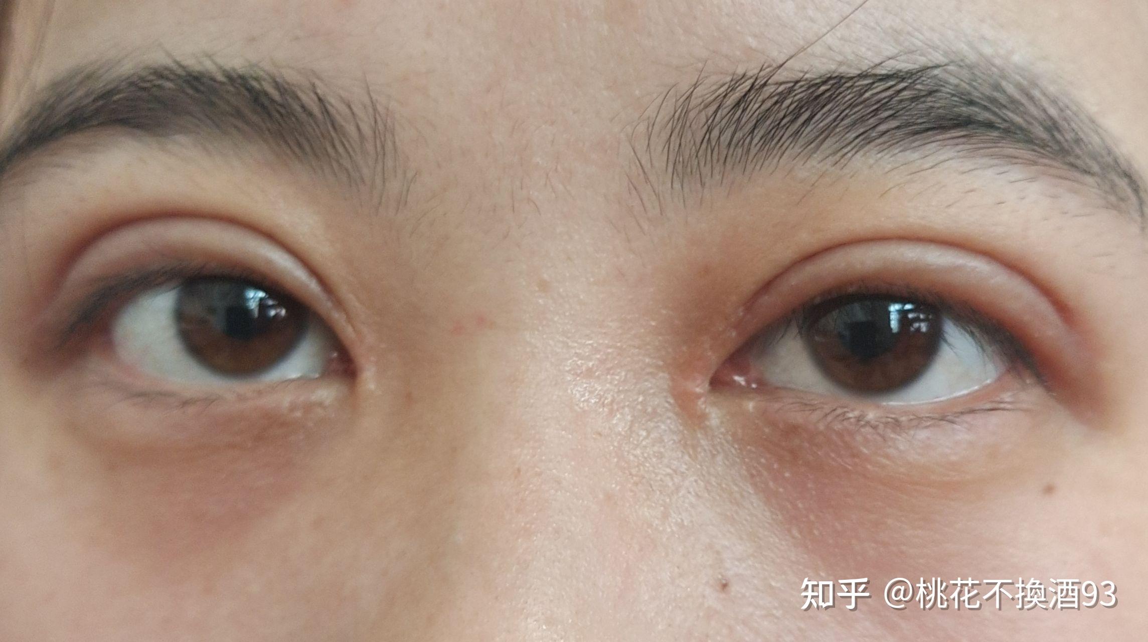 韓式小切口雙眼皮 | 台北眼部整形推薦 - 劉淳熙醫師美眼網