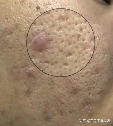 图片慎点这属于器质性毛孔粗大吗护肤品还有救不哭