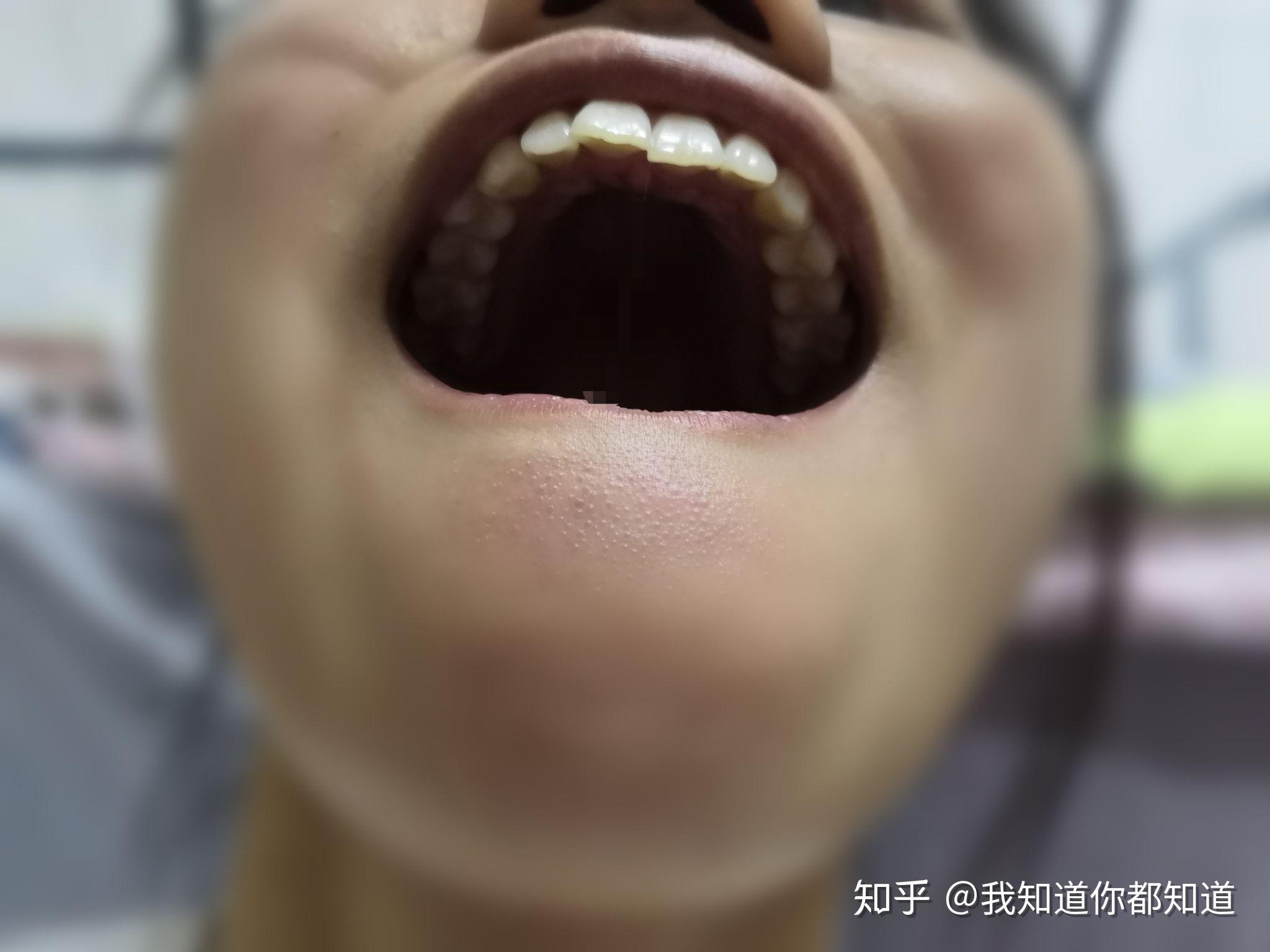 只有一颗门牙是歪的能箍呀么大概需要多少钱今年17岁女因为门牙有些