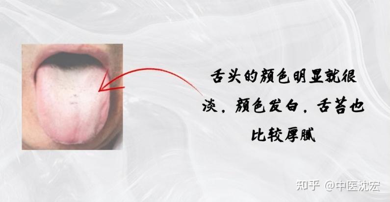 痰湿一祛,万病全消,老中医清痰除痰的绝招,痰湿体质看过来 - 知乎