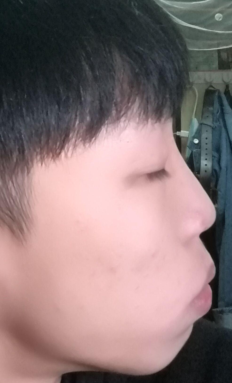 上牙外凸严重怎么办