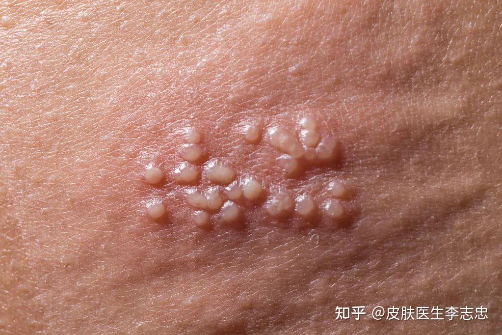 带状疱疹后遗症神经痛非常严重,如何治疗? - 知乎