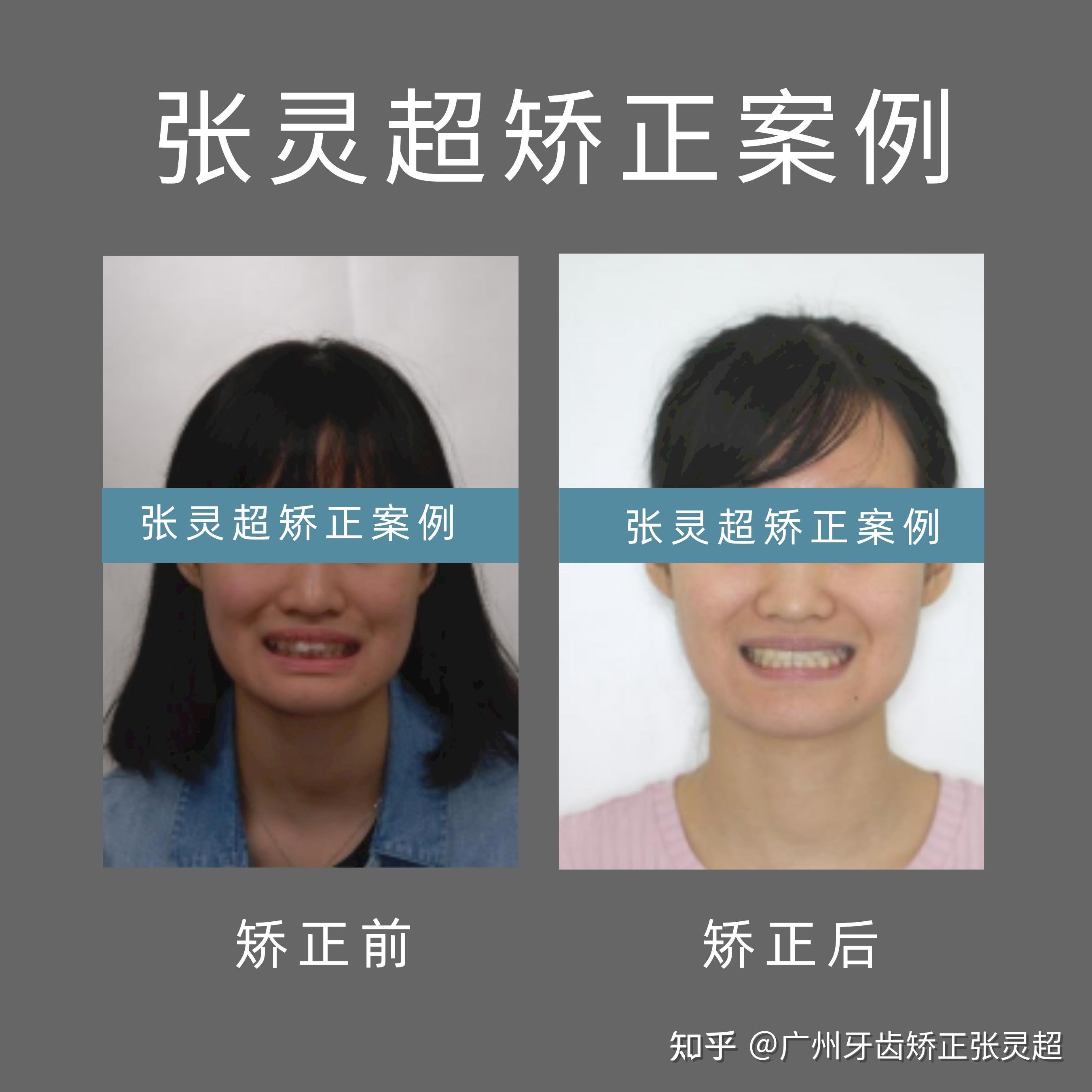 广州牙齿矫正(正畸)|近期,深覆合深覆盖合集