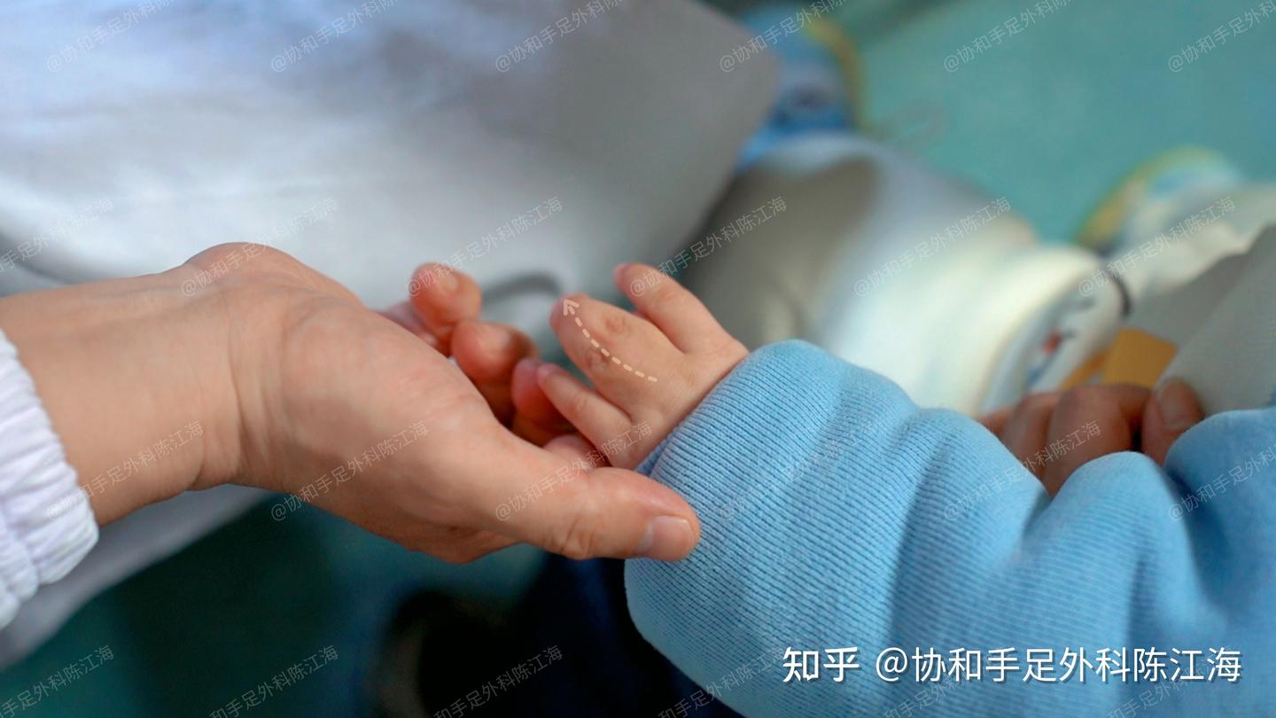 宝宝并指是怎么回事?人工真皮是真的皮肤吗? - 知乎