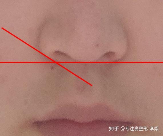 鼻小柱凹陷与鼻翼缘后缩的区别