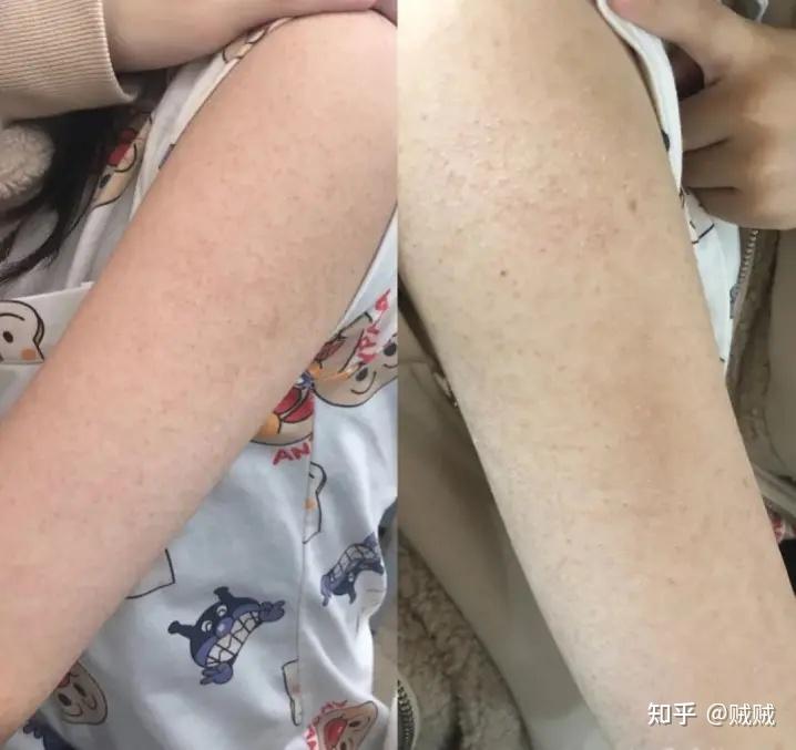 鸡皮肤咋办除去(怎么能去除鸡皮肤) 鸡皮肤咋办除去(怎么能去除鸡皮肤)