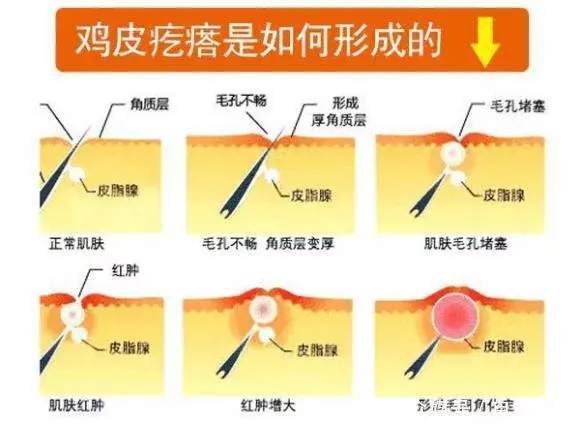 如患鸡皮肤该如何医治(鸡皮肤是什么原因引起的,该怎么治疗)