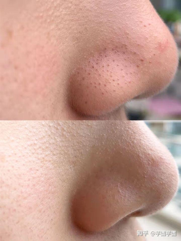 毛孔长摸起来刺刺的拔出来后一条白白硬硬的是什么东西呀? - 知乎