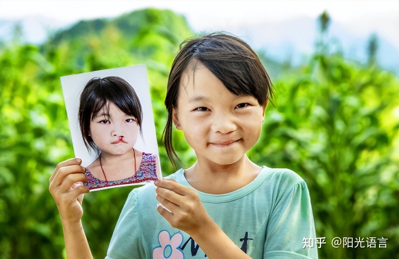 唇腭裂冷知识宝宝鼻子上夹的是什么和语音训练有关系吗