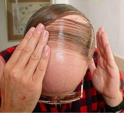 头发脱成地中海怎么办只有这两种办法才能解决脱发问题