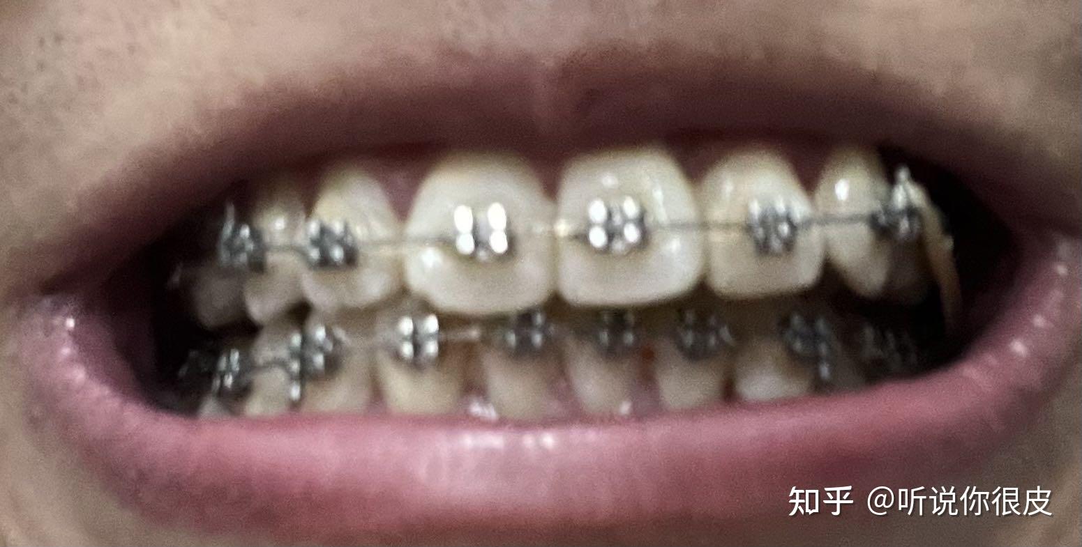郑州牙齿矫正|记录我整牙2年内收5mm的变化 - 知乎