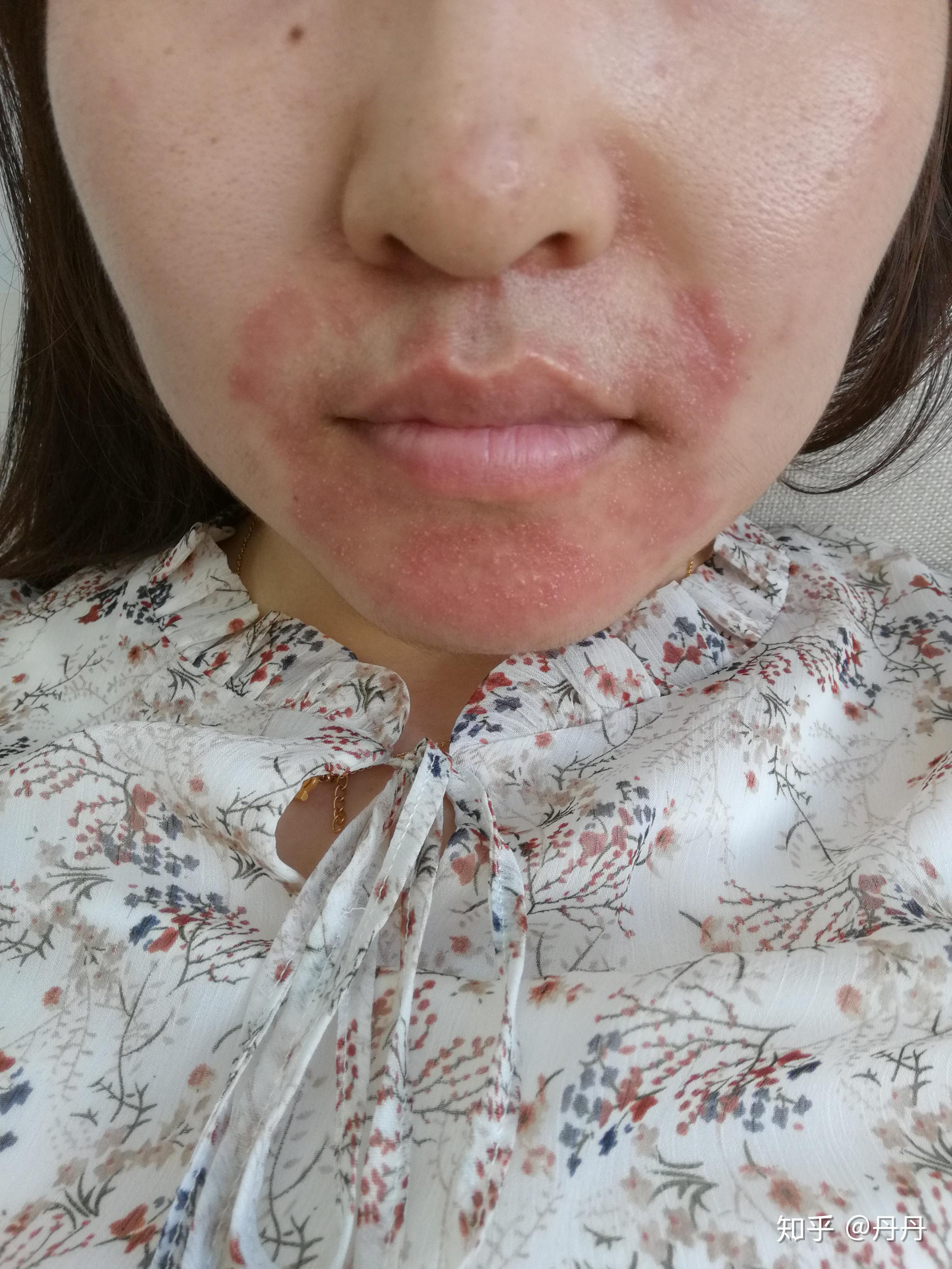 如何治疗面部脂溢性皮炎困扰我n年了求各位大神给我一些能彻底治疗的