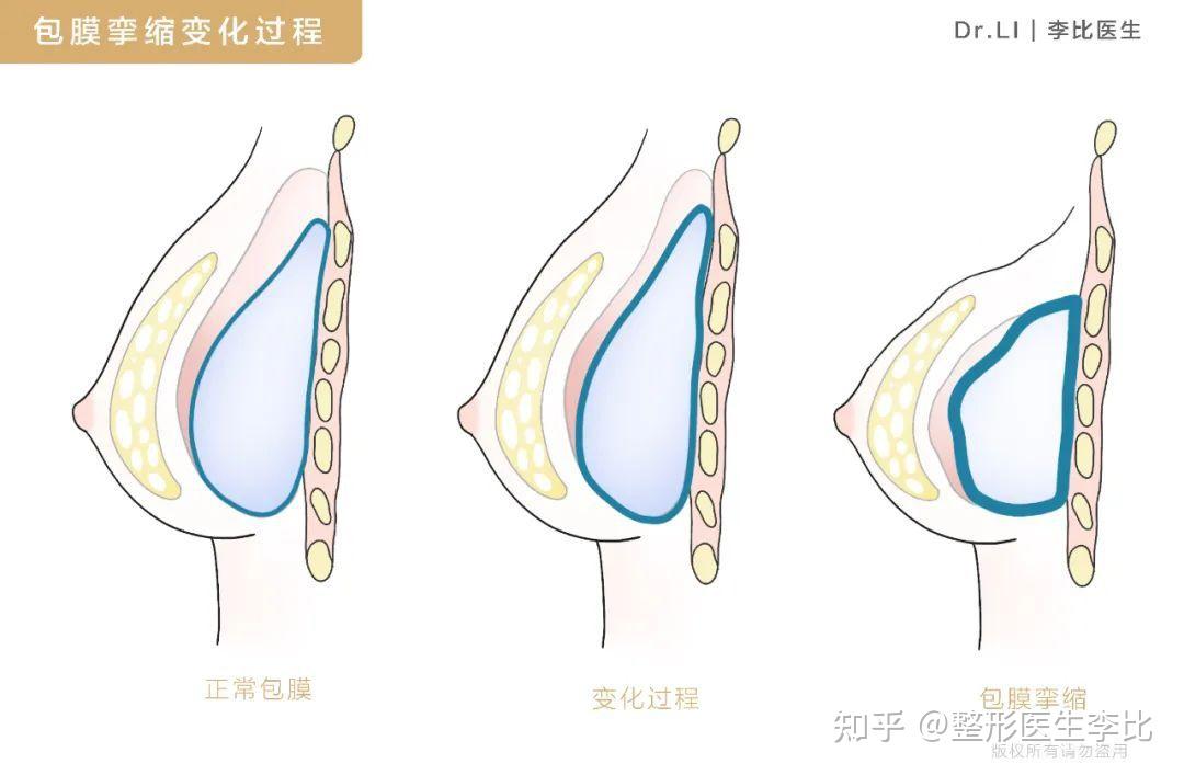 假體隆胸後會變形嗎?姑娘們包膜攣縮瞭解一下! - 知乎