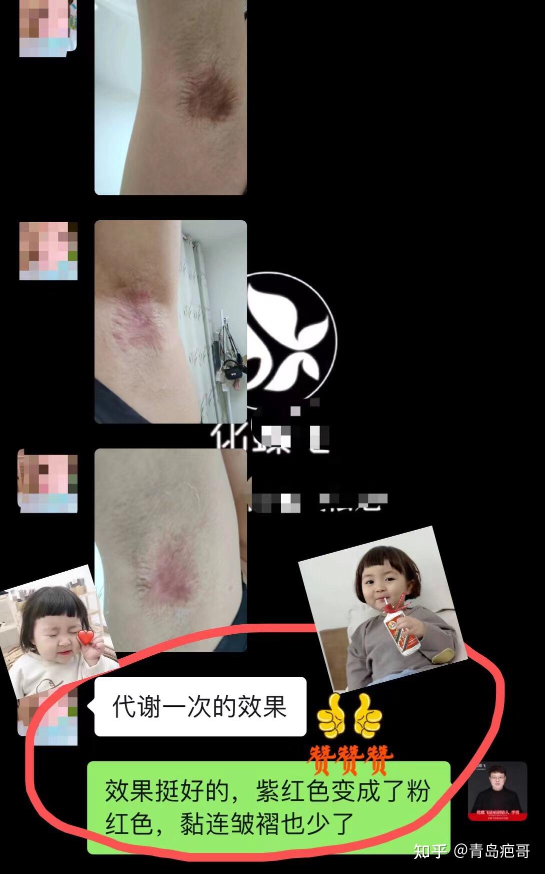 四川美女三年的腋下手术疤痕