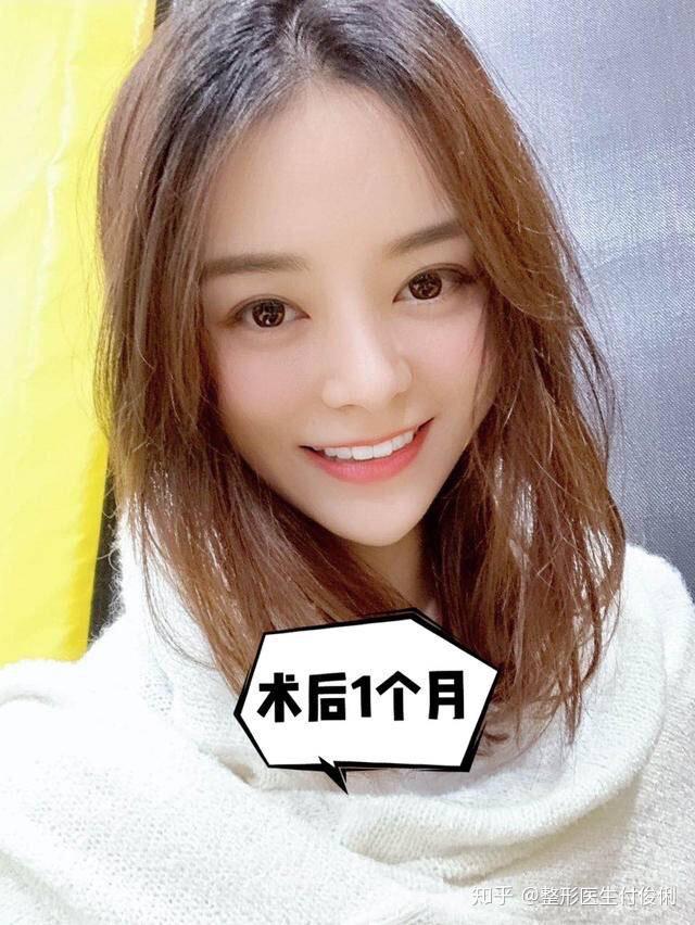 鼻子又宽又大鼻综合术后神似阿娇