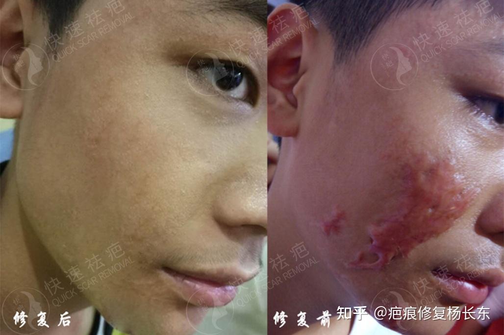 疤痕增生如何有效消除