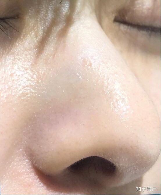 这是角质型毛孔粗大吗