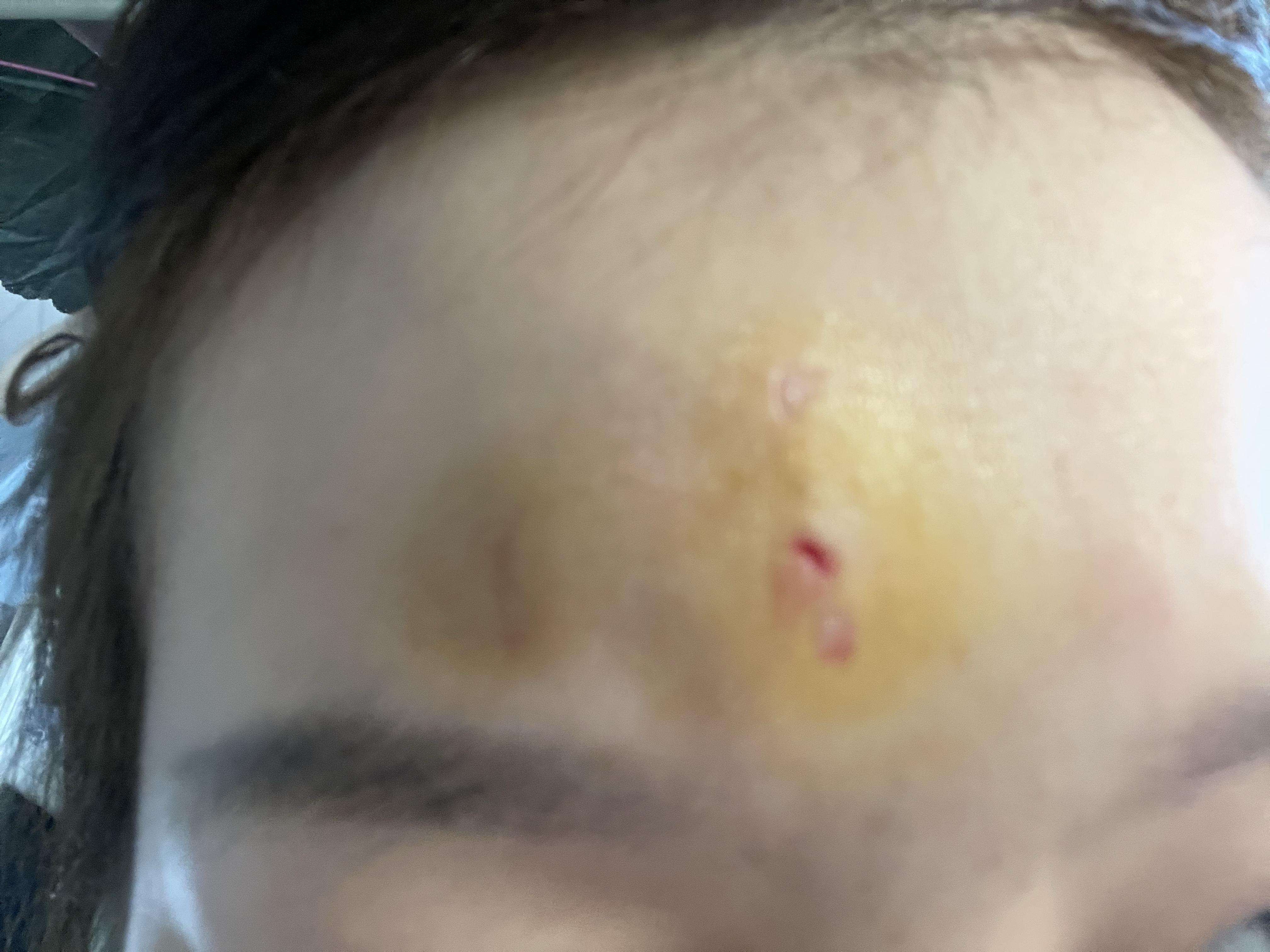 额头磕伤了一个2mm左右的伤口,流了血会留疤吗?
