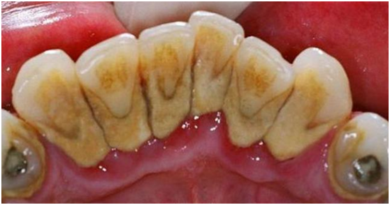 牙周病就只能牙周手术?牙周病的非手术治疗技术 