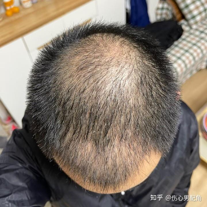 秃头对男生的打击有多大？ - 知乎