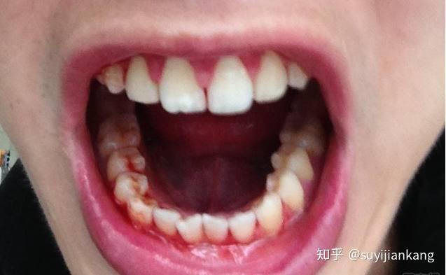 解析梦境，我昨晚梦见掉了三颗牙，满嘴都是血，究竟意味着什么？