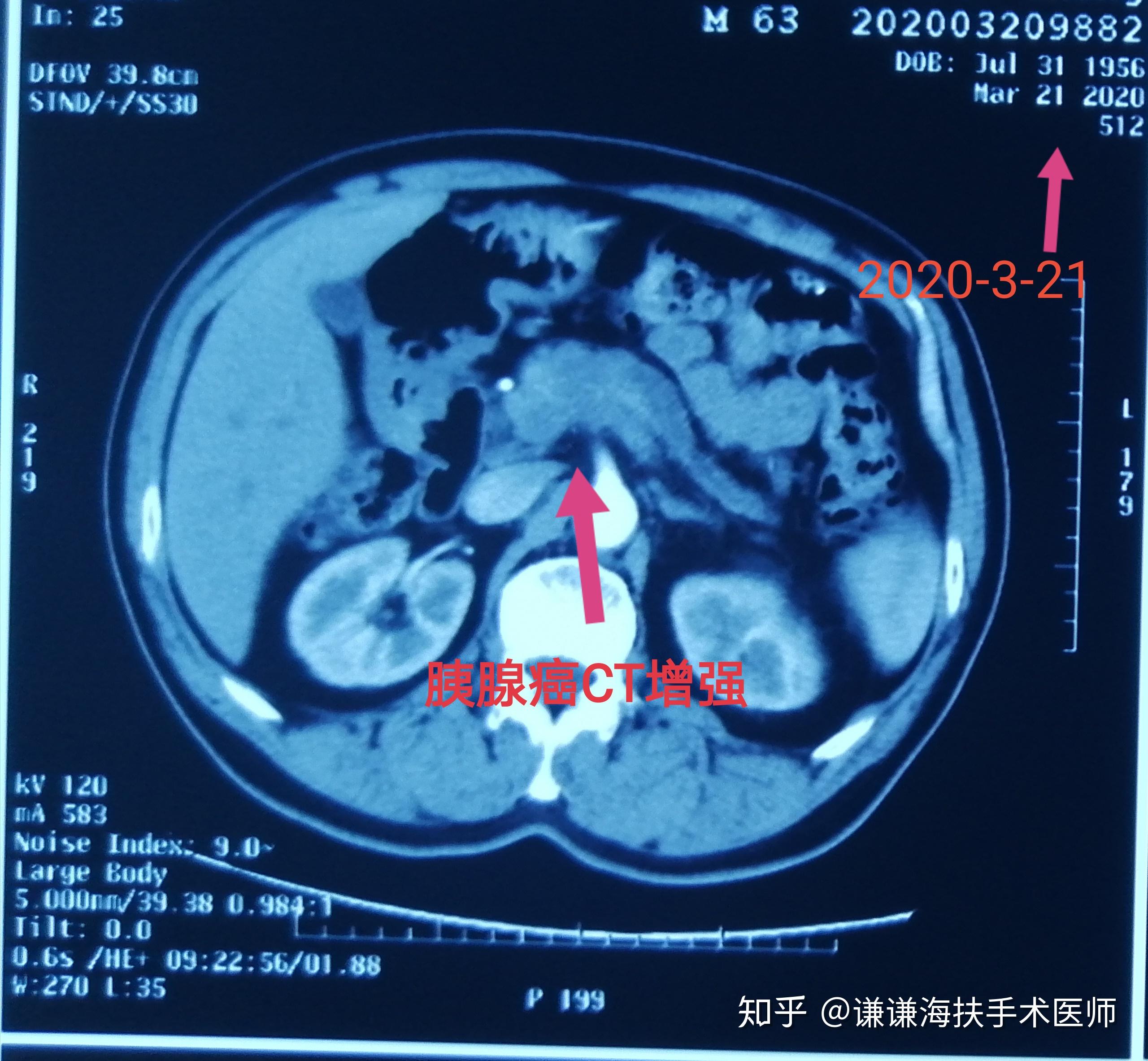 陈谦主任科普之早期胰腺癌治疗病例