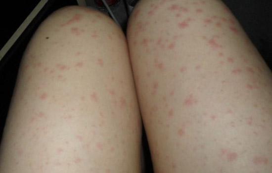 大腿毛囊炎怎么护理