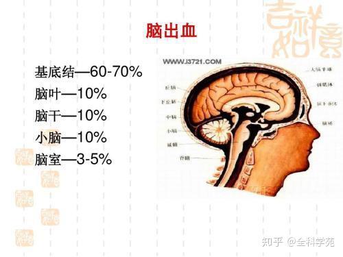 不同部位脑出血的临床表现