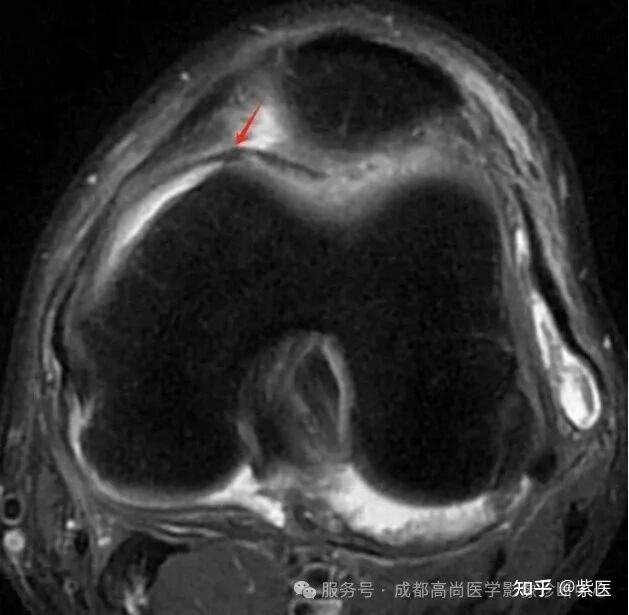 膝关节滑膜皱襞综合征(MPS)MR诊断 - 知乎