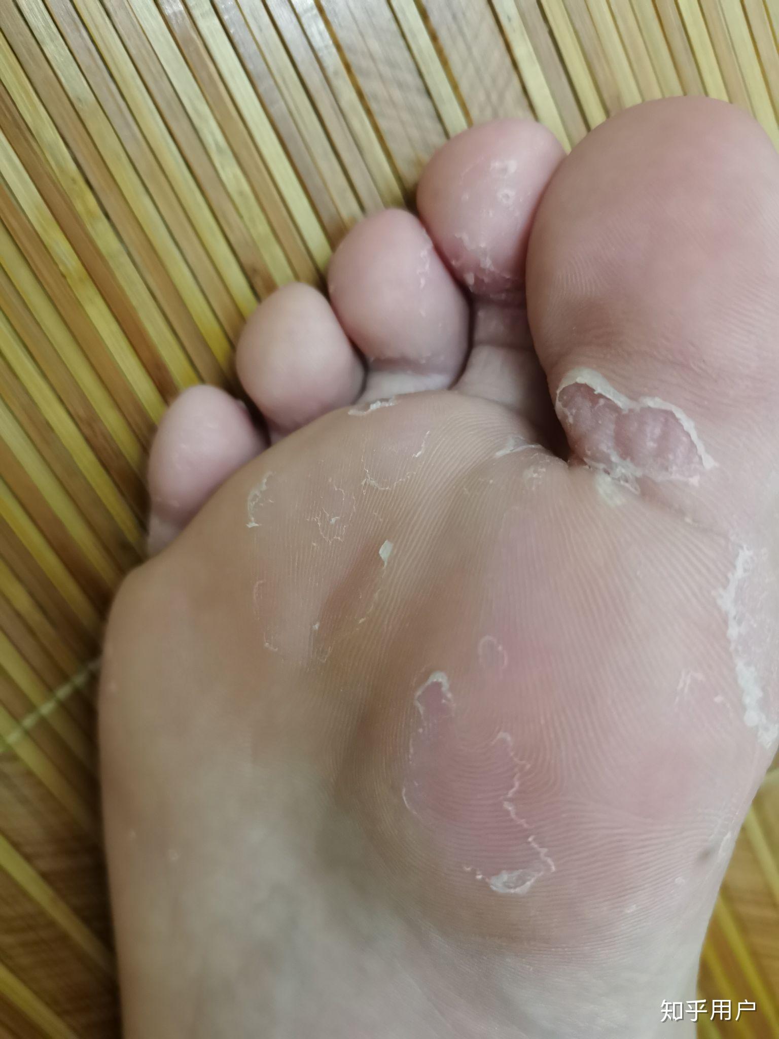 脚缝间脱皮怎么办,不痛不痒不臭? - 知乎