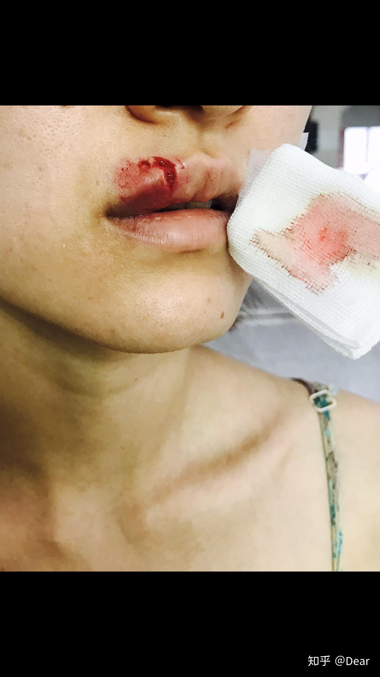 缝针和拆线可怕吗疼吗你们当时怕吗