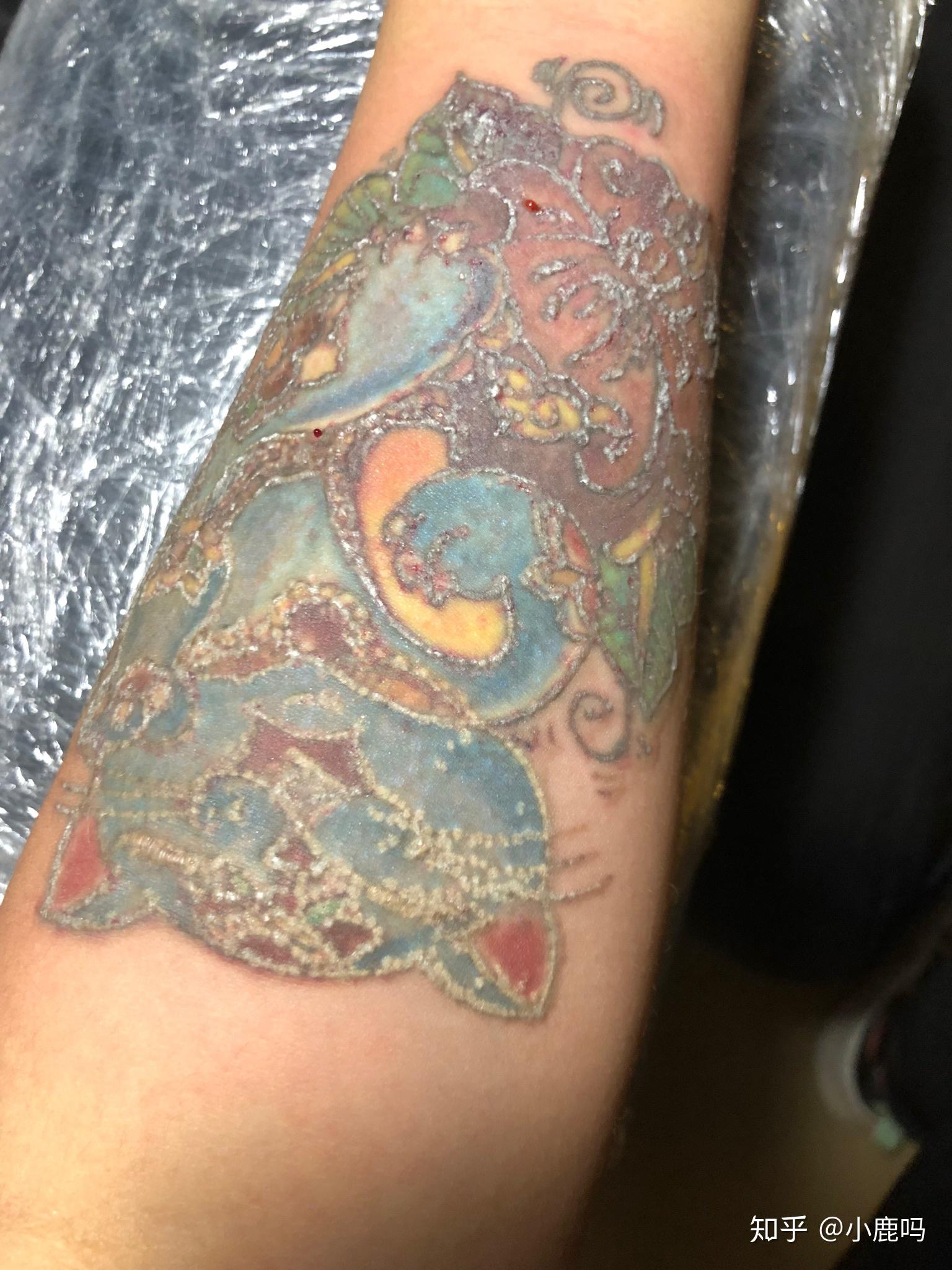 激光洗纹身第二次